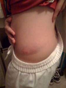 the bruise that night